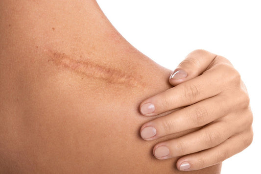 Can Tallow Actually Help Heal Scars? - INSHA