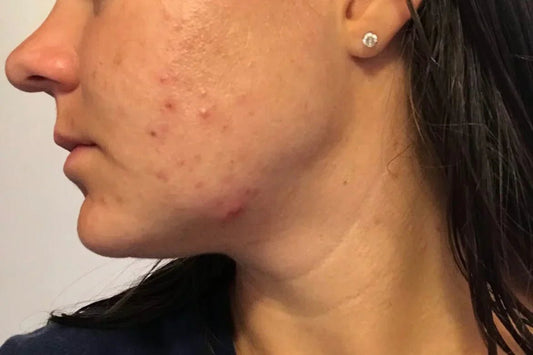 How Beef Tallow Helps Reduce Skin Redness and Inflammation - INSHA